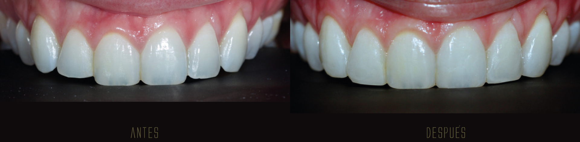 estetica dental resinas directas