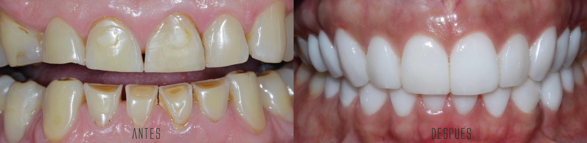 estetica dental con resinas indirectas